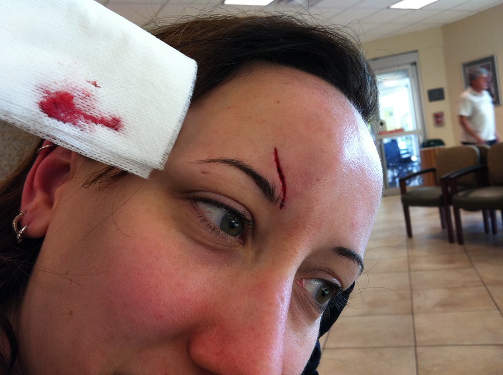 Slip and Fall Injury cut above right eye